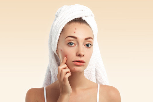 Finally, A Skincare Solution That Understands Adult Acne